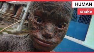 Boy dubbed 'human snake' due to rare skin condition | SWNS