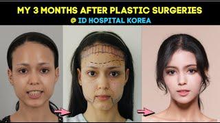 MY PLASTIC SURGERY EXPERIENCE IN KOREA l 3 MONTHS AFTER