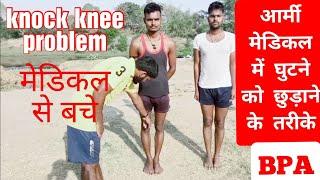 Knock knee problem How to remove and top exercise in Hindi