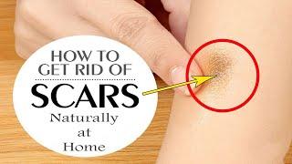 How to Get Rid of Scars || Top 10 Natural Scar Erasers || Home Remedies for Scars