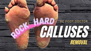 Rock Hard Calluses:  Removal of Multiple Stubborn Hard Calluses (Pre-COVID)