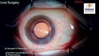 Live surgery from Nandadeep Eye Hospital Dr Sourabh Patwardhan