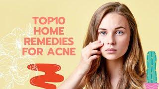 TOP 10 HOME REMEDIES FOR ACNE