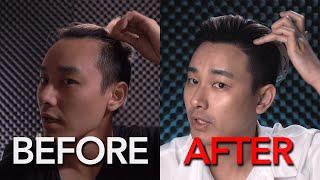 Hair Transplant in Korea Results After 1 Year